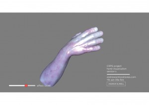 Work in progress CRPS 3D model, image by courtesy of Dr Andrew Burrell